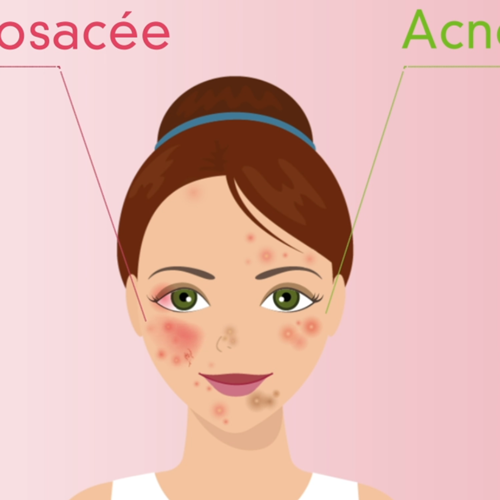 rosacee-vs-acne