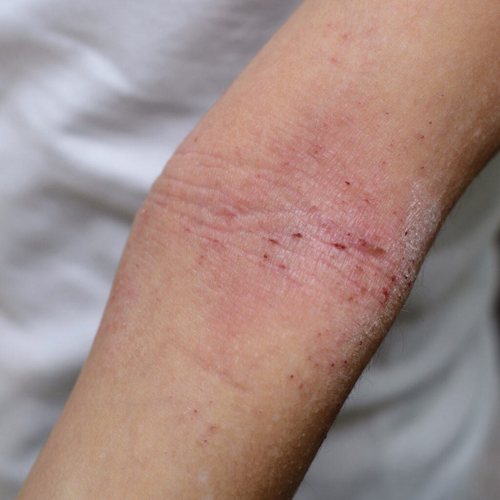 Dermatite-atopique-eczema