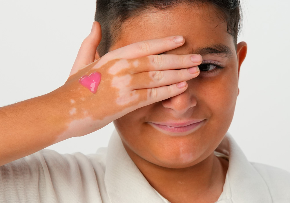 Vitiligo : causes, symptômes et traitements - Isispharma France