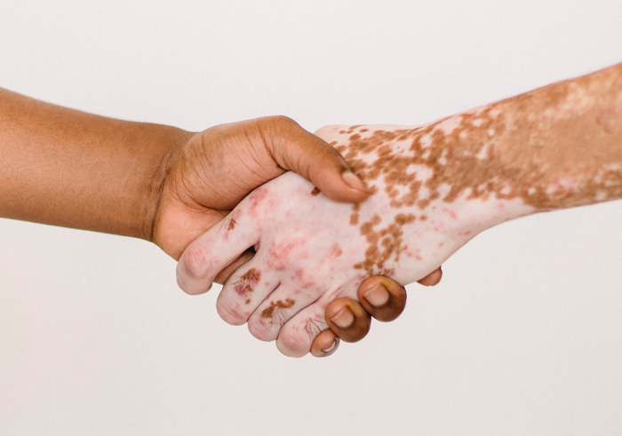 Vitiligo : causes, symptômes et traitements - Isispharma France